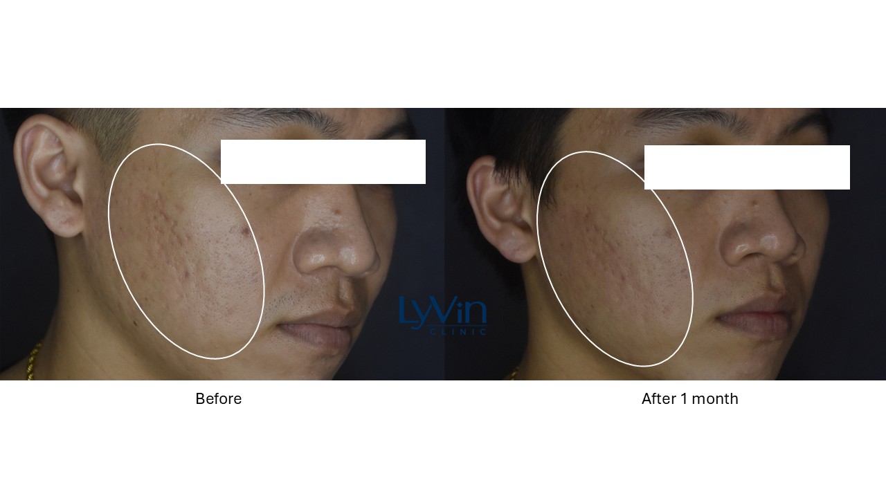 Acne scar reduction with Potenza RF Microneedling – before and after